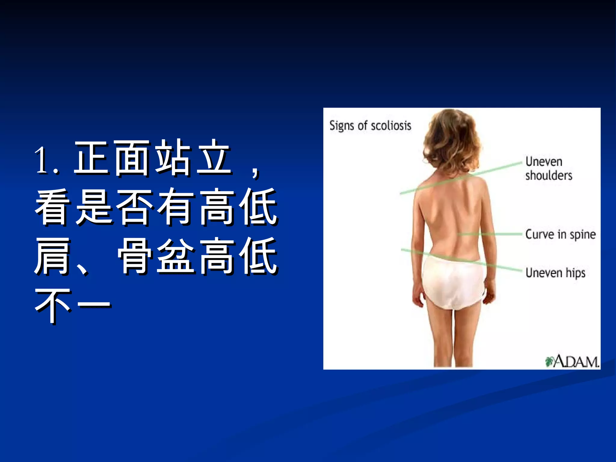 1. 正面站立，看是否有高低肩、骨盆高低不一 