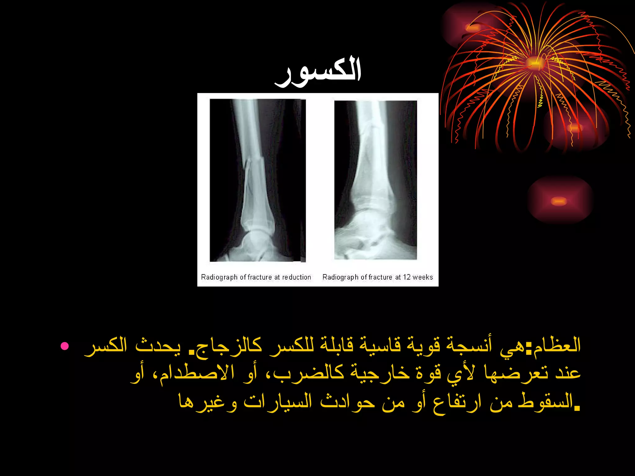 الكسور العظام : هي أنسجة قوية قاسية قابلة للكسر كالزجاج .  يحدث الكسر عند تعرضها لأي قوة خارجية كالضرب، أو الاصطدام، أو السقوط من ارتفاع أو من حوادث السيارات وغيرها . 