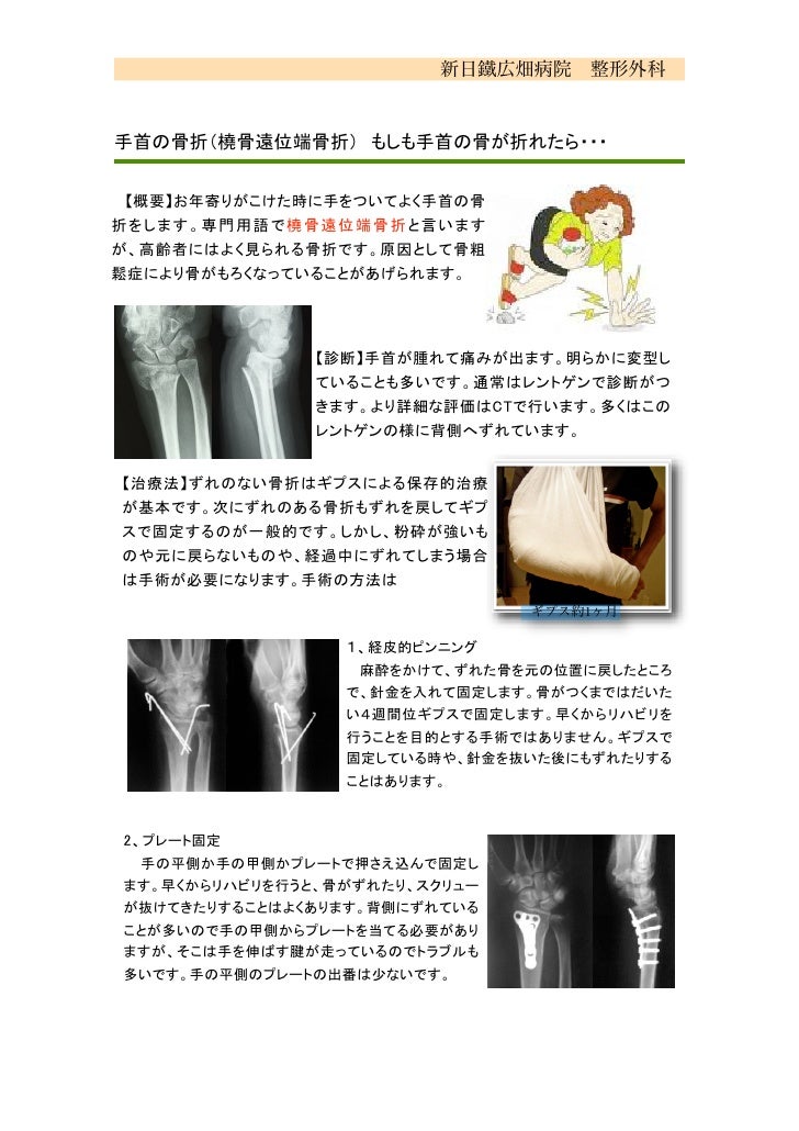 手首の骨折患者教育用 手首の骨折患者教育用