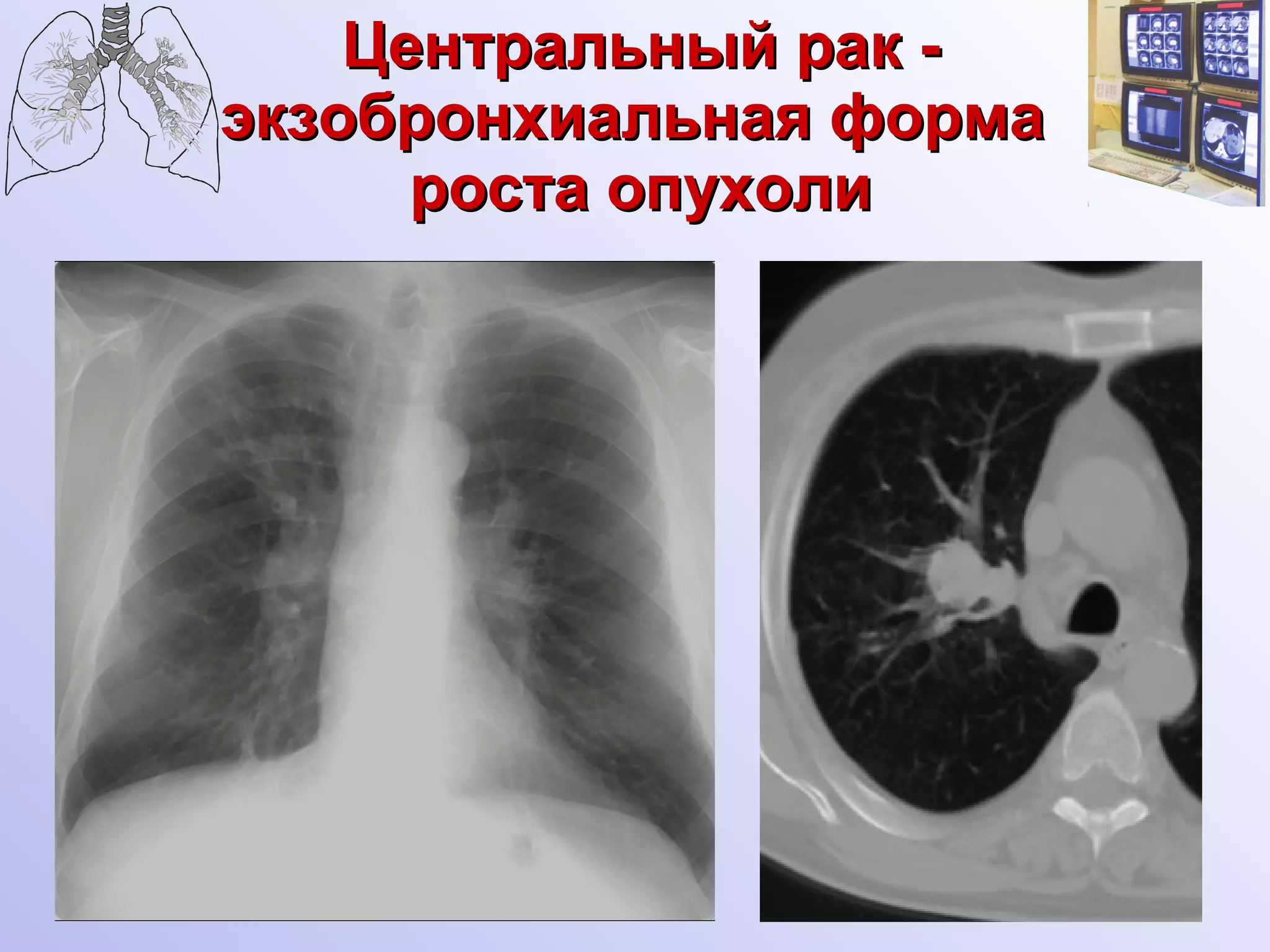 Центральный рак - экзобронхиальная форма  роста опухоли 