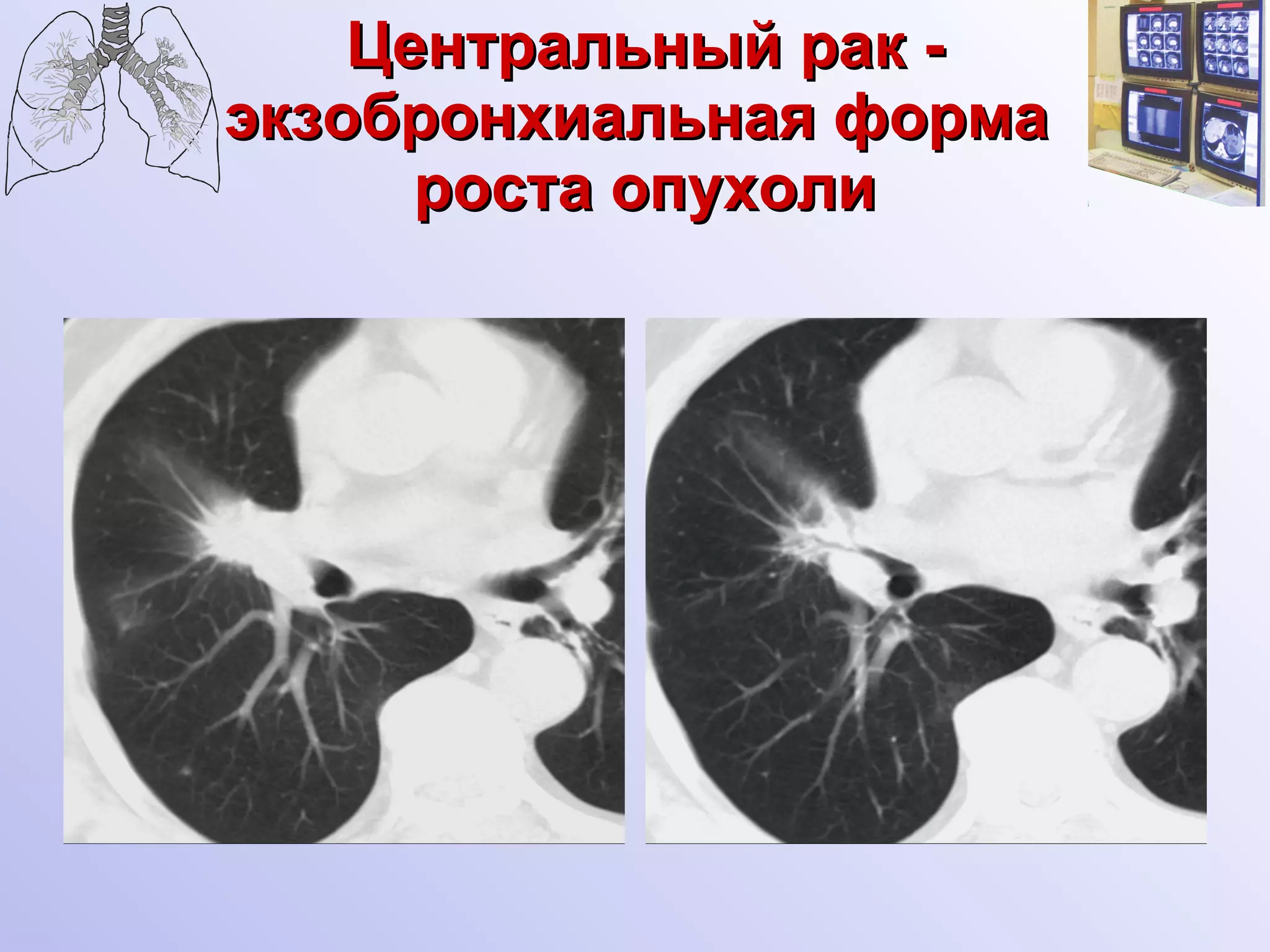 Центральный рак - экзобронхиальная форма  роста опухоли 