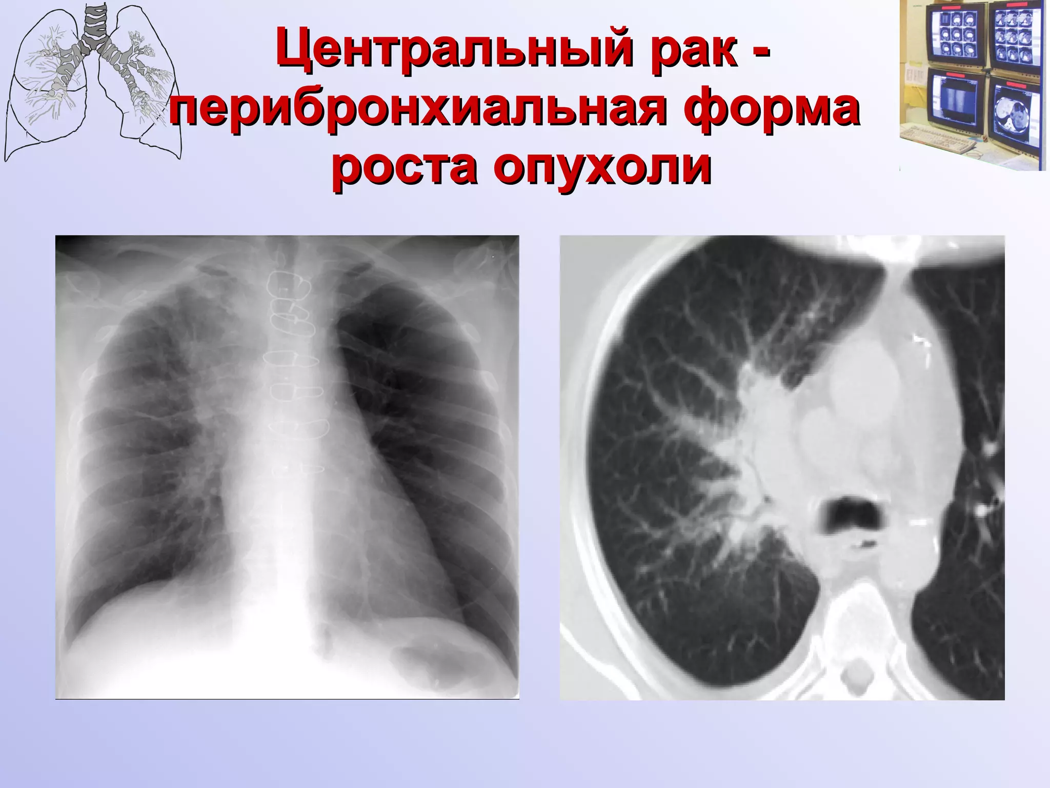 Центральный рак - перибронхиальная форма  роста опухоли 