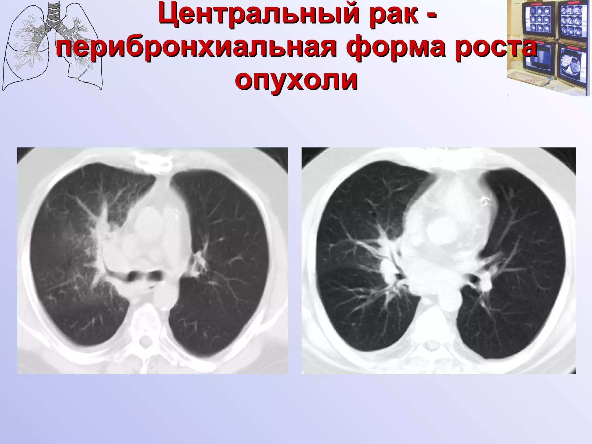 Центральный рак - перибронхиальная форма роста опухоли 