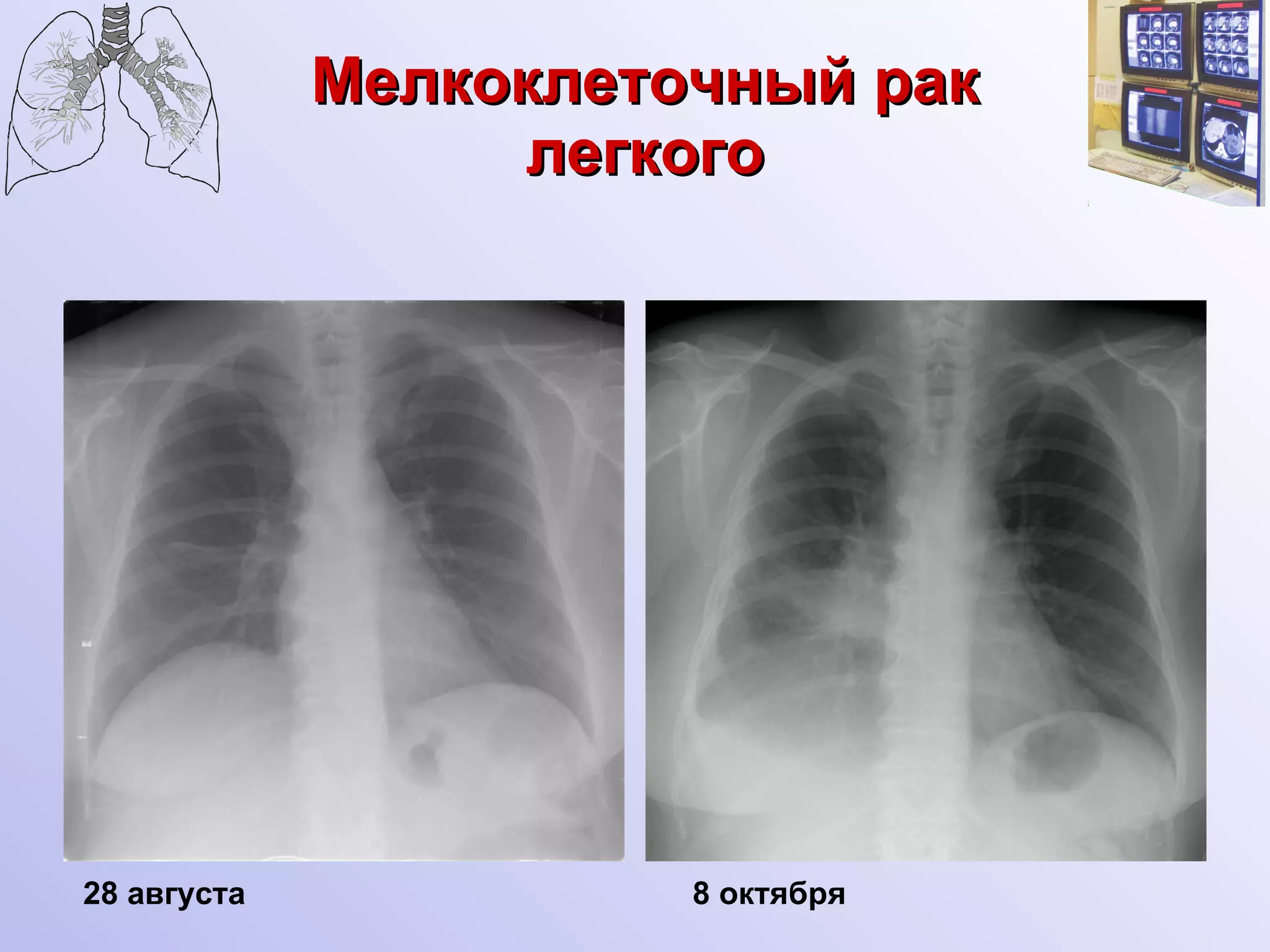 Мелкоклеточный рак легкого 8  октября 28 августа 