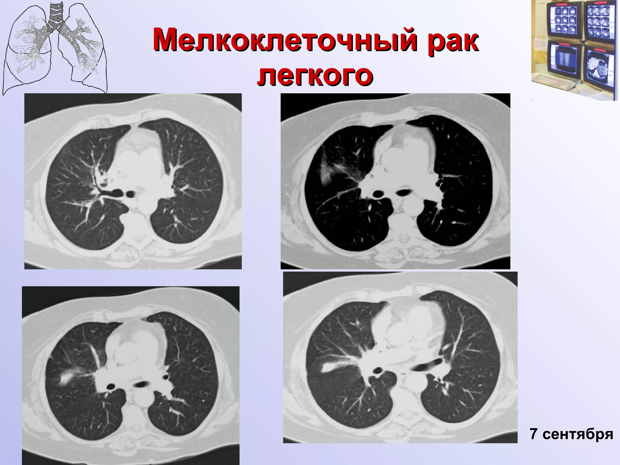 Мелкоклеточный рак легкого 7 сентября 
