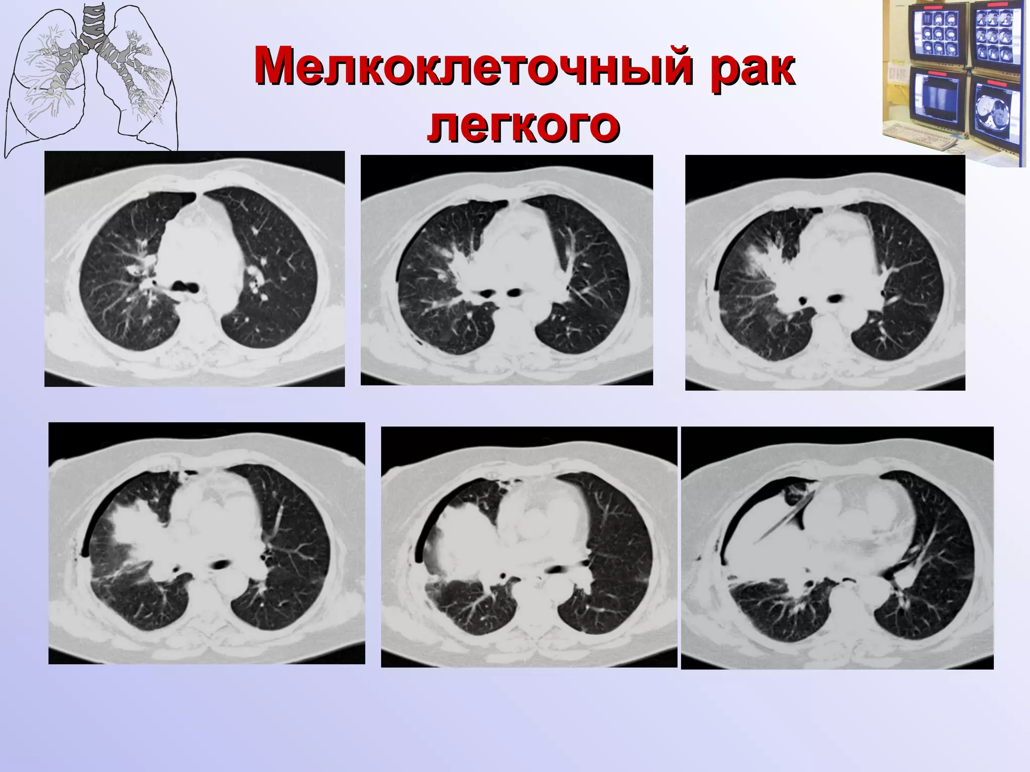 Мелкоклеточный рак легкого 
