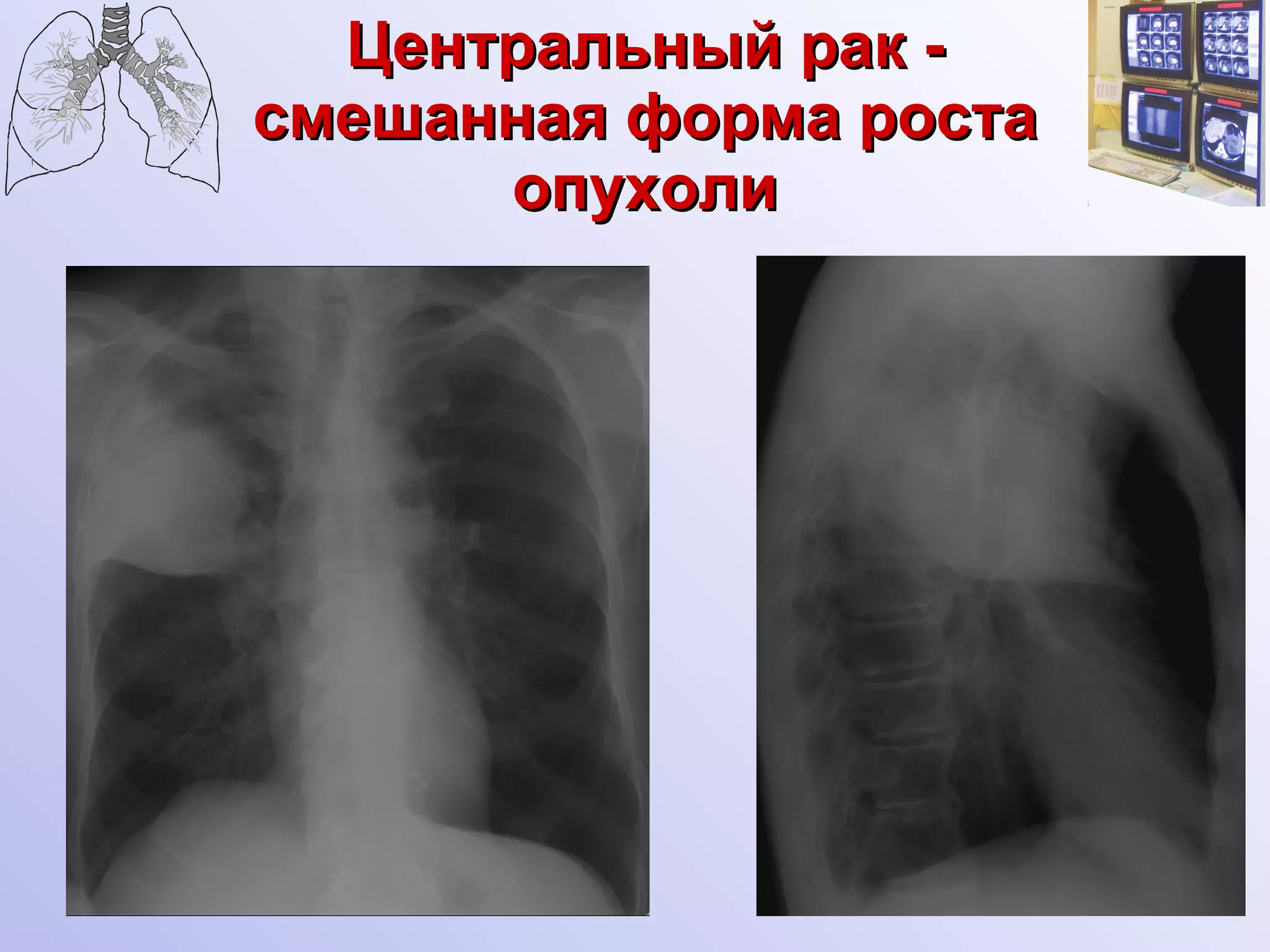 Центральный рак - смешанная форма роста опухоли 