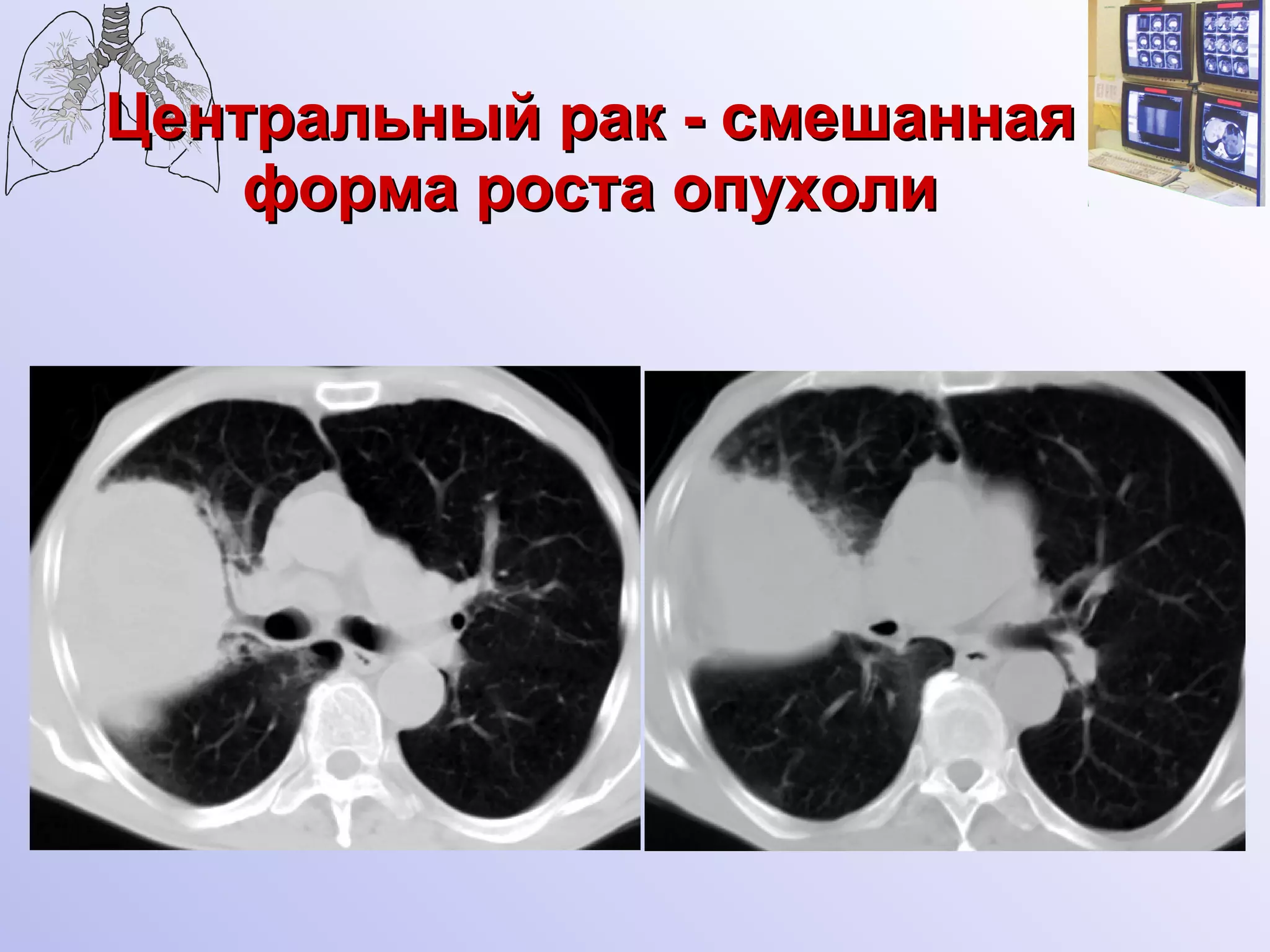 Центральный рак - смешанная форма роста опухоли 