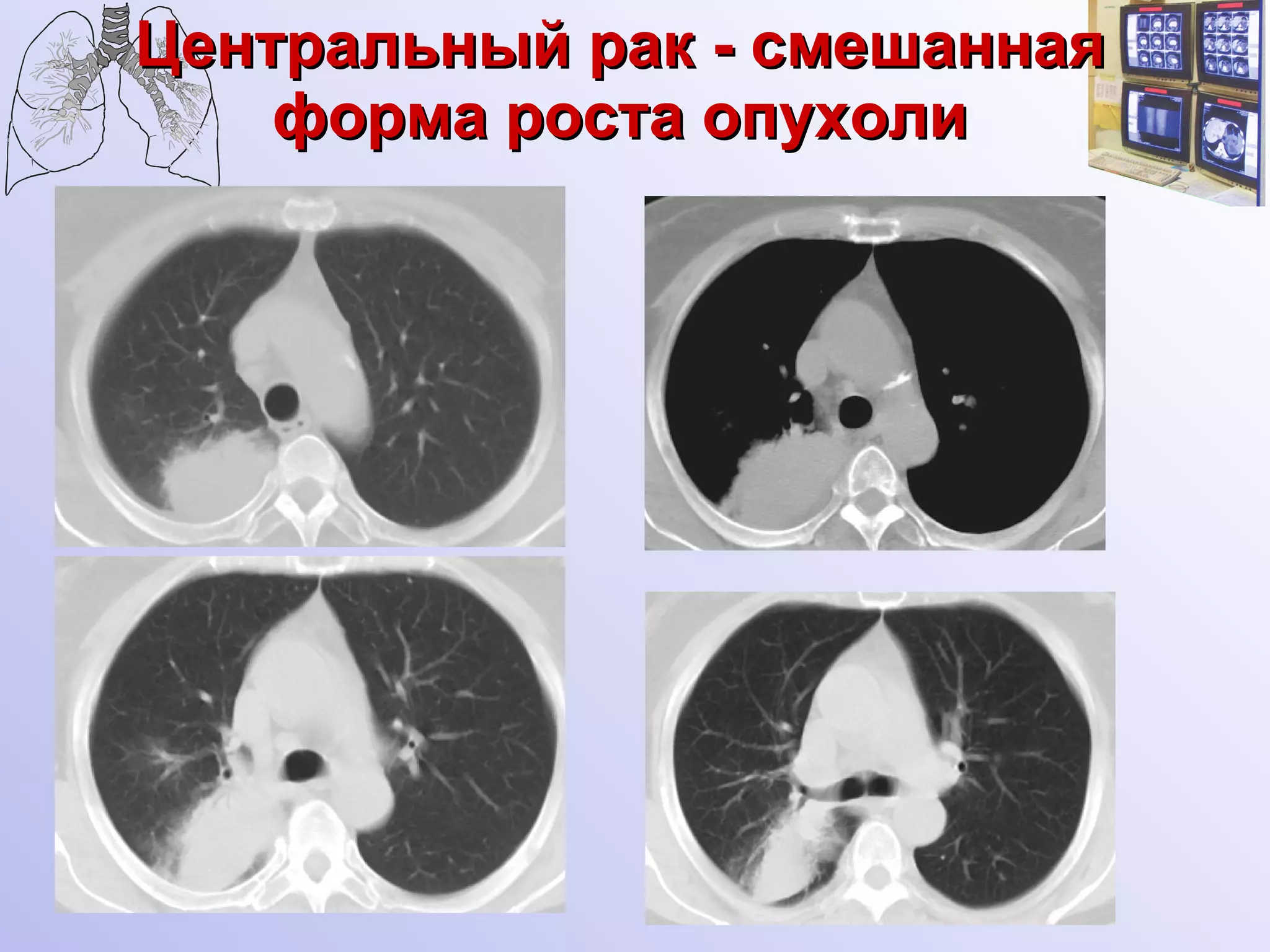 Центральный рак - смешанная форма роста опухоли 