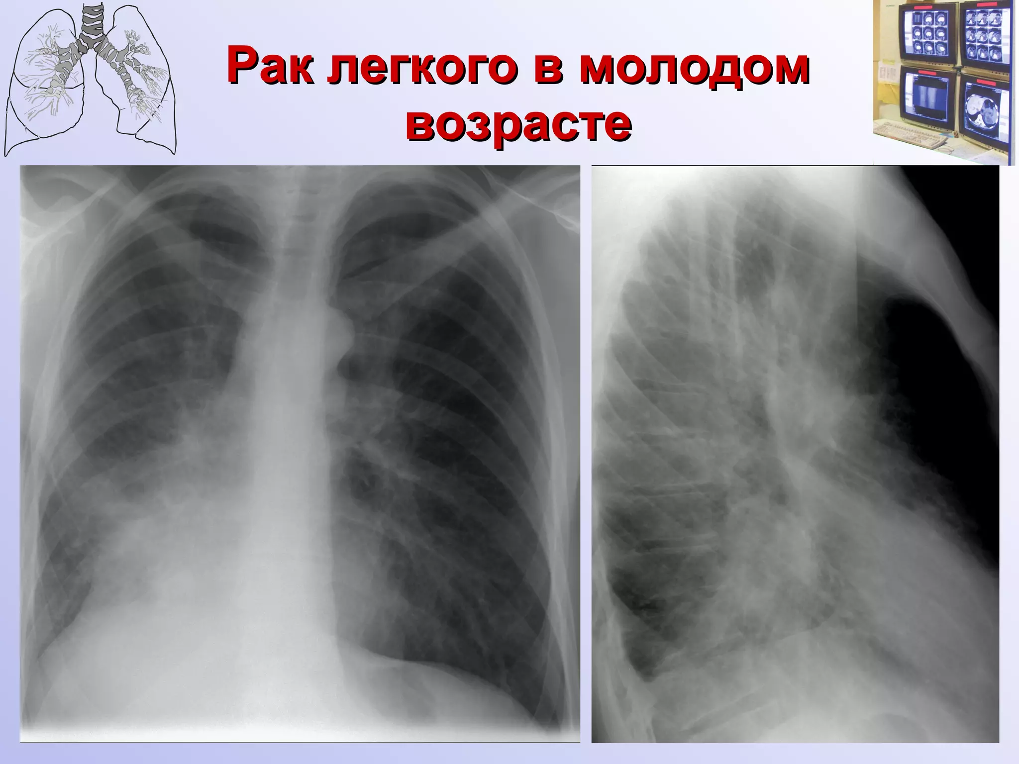 Рак легкого в молодом возрасте 