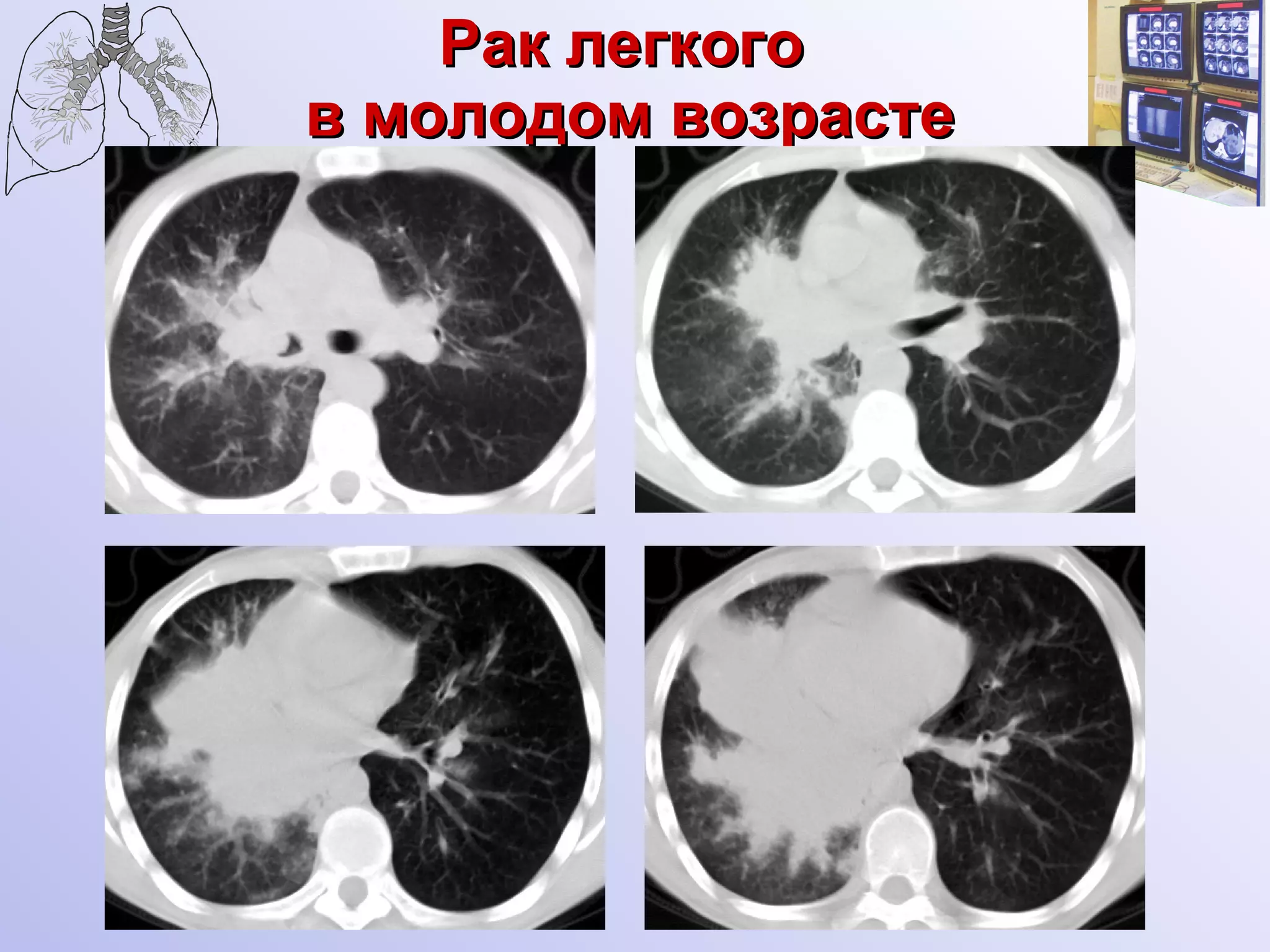 Рак легкого  в молодом возрасте 