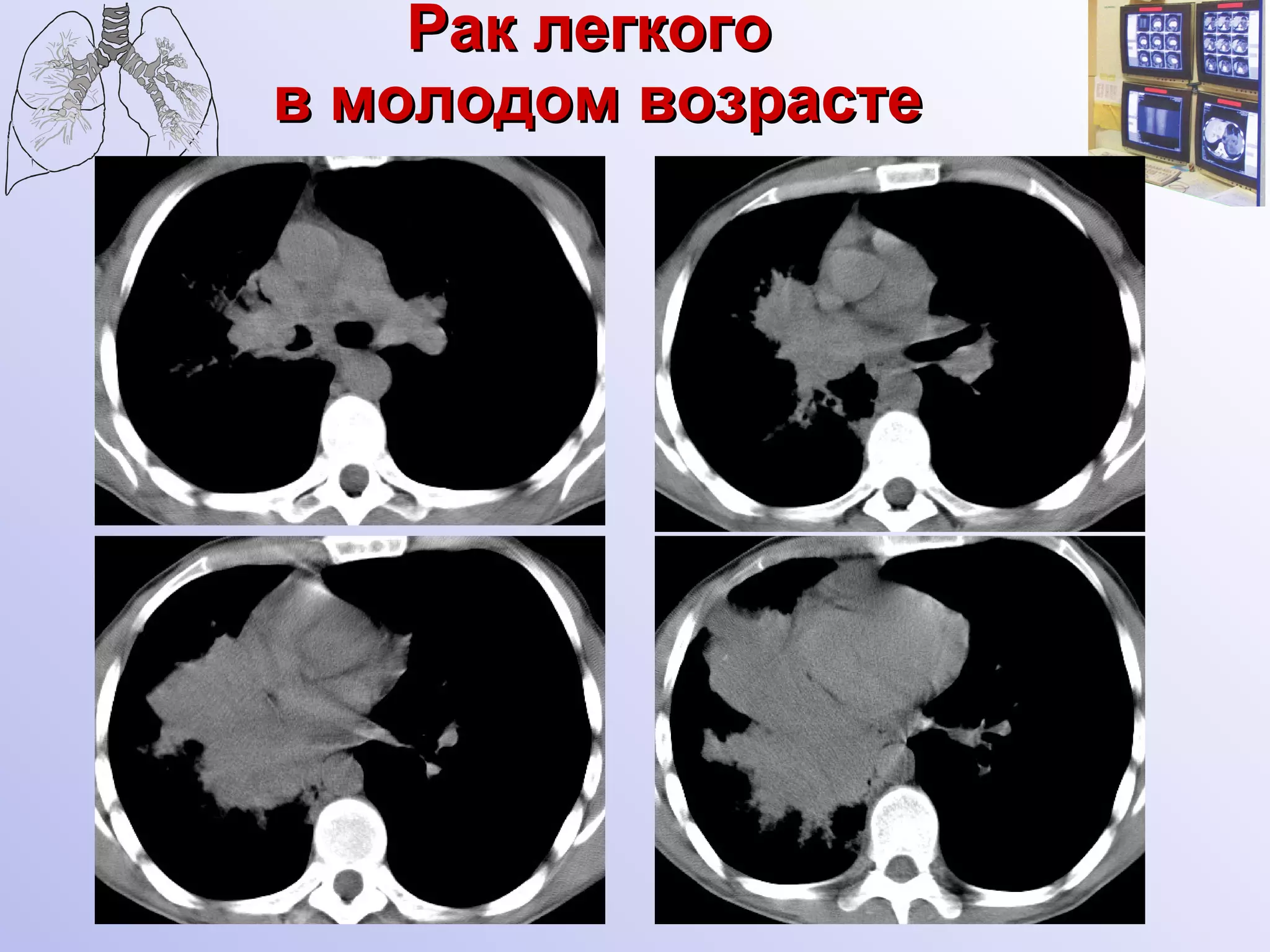 Рак легкого  в молодом возрасте 