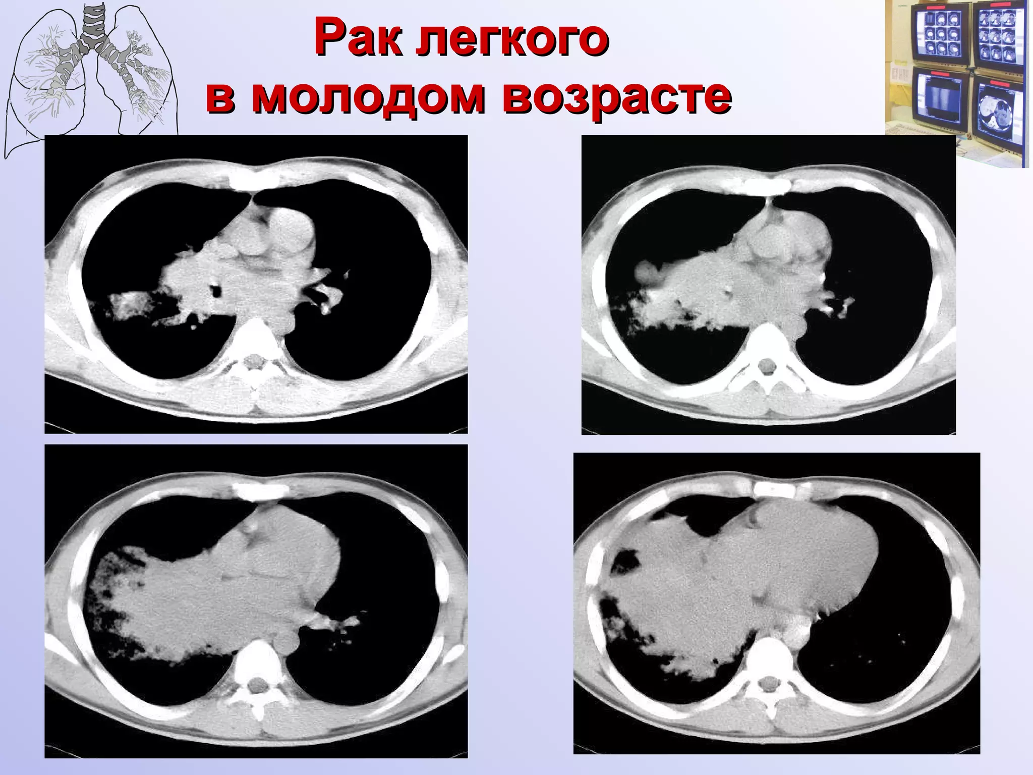 Рак легкого  в молодом возрасте 