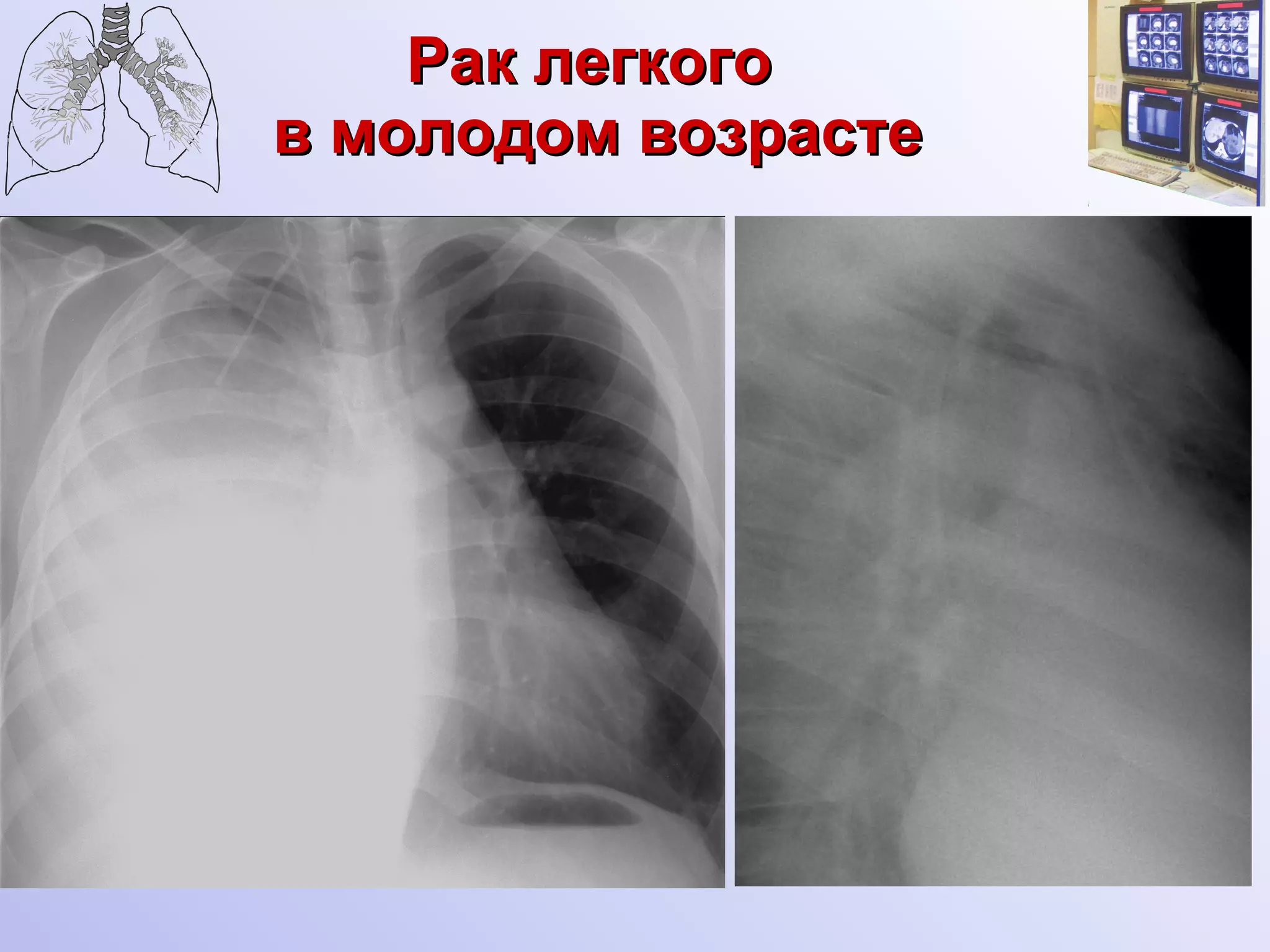 Рак легкого  в молодом возрасте 