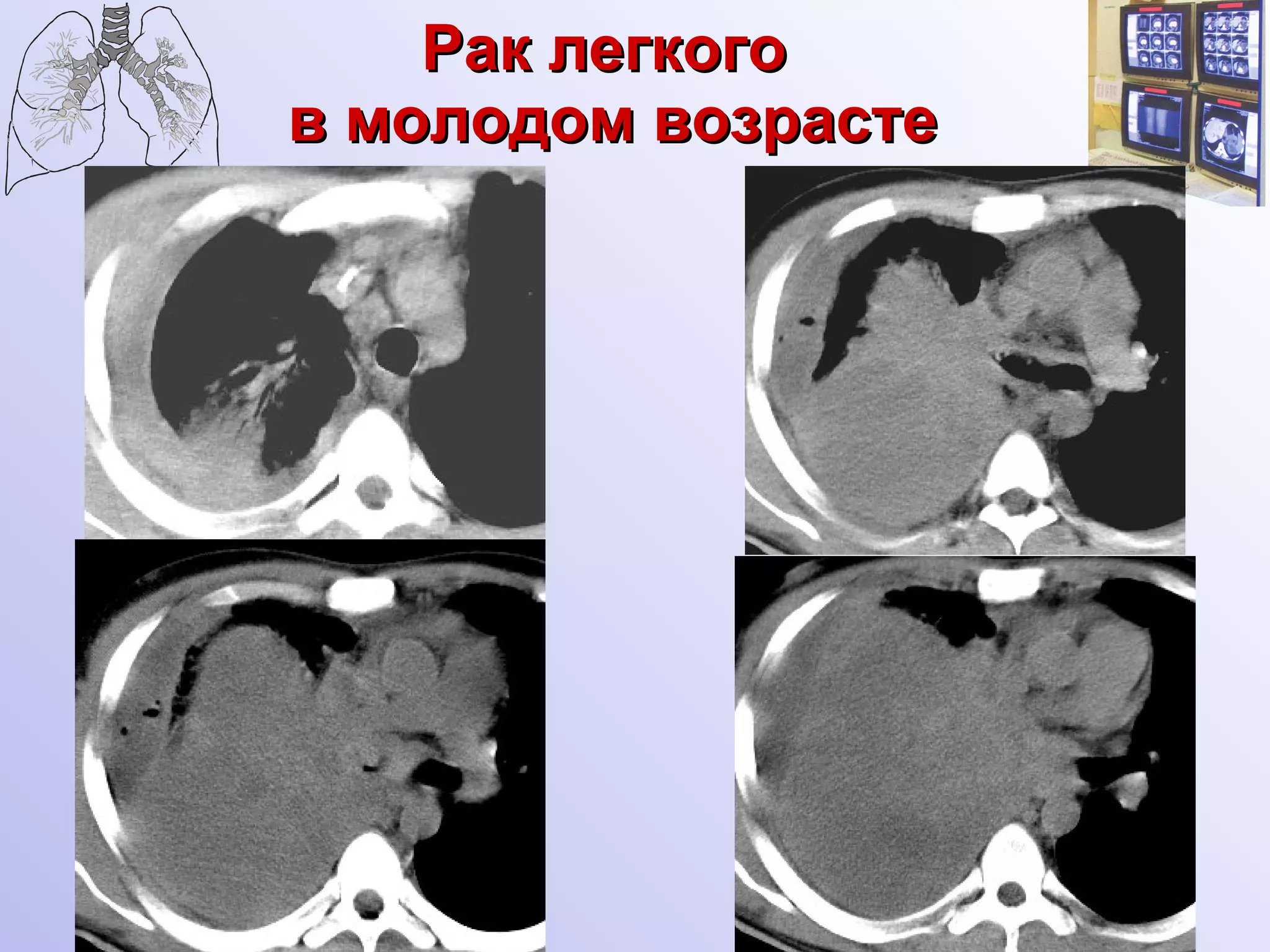 Рак легкого  в молодом возрасте 