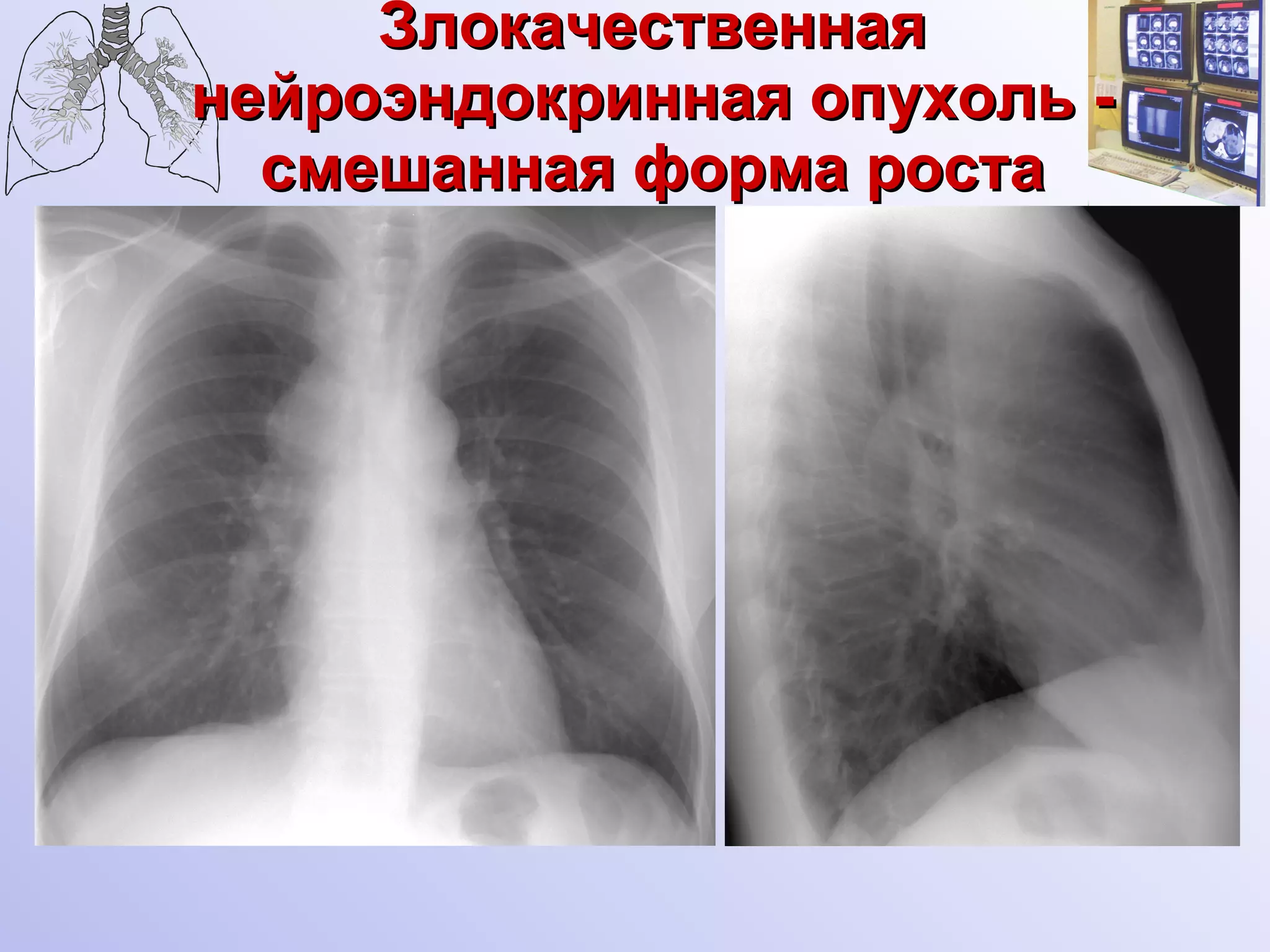Злокачественная нейроэндокринная опухоль - смешанная форма роста 