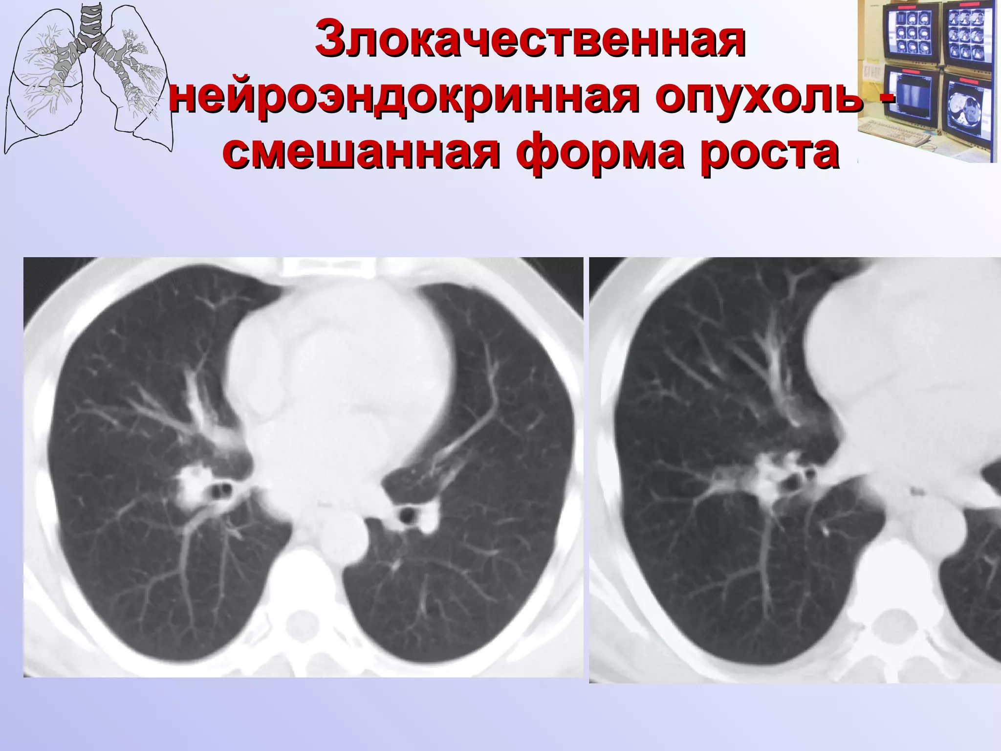 Злокачественная нейроэндокринная опухоль - смешанная форма роста 