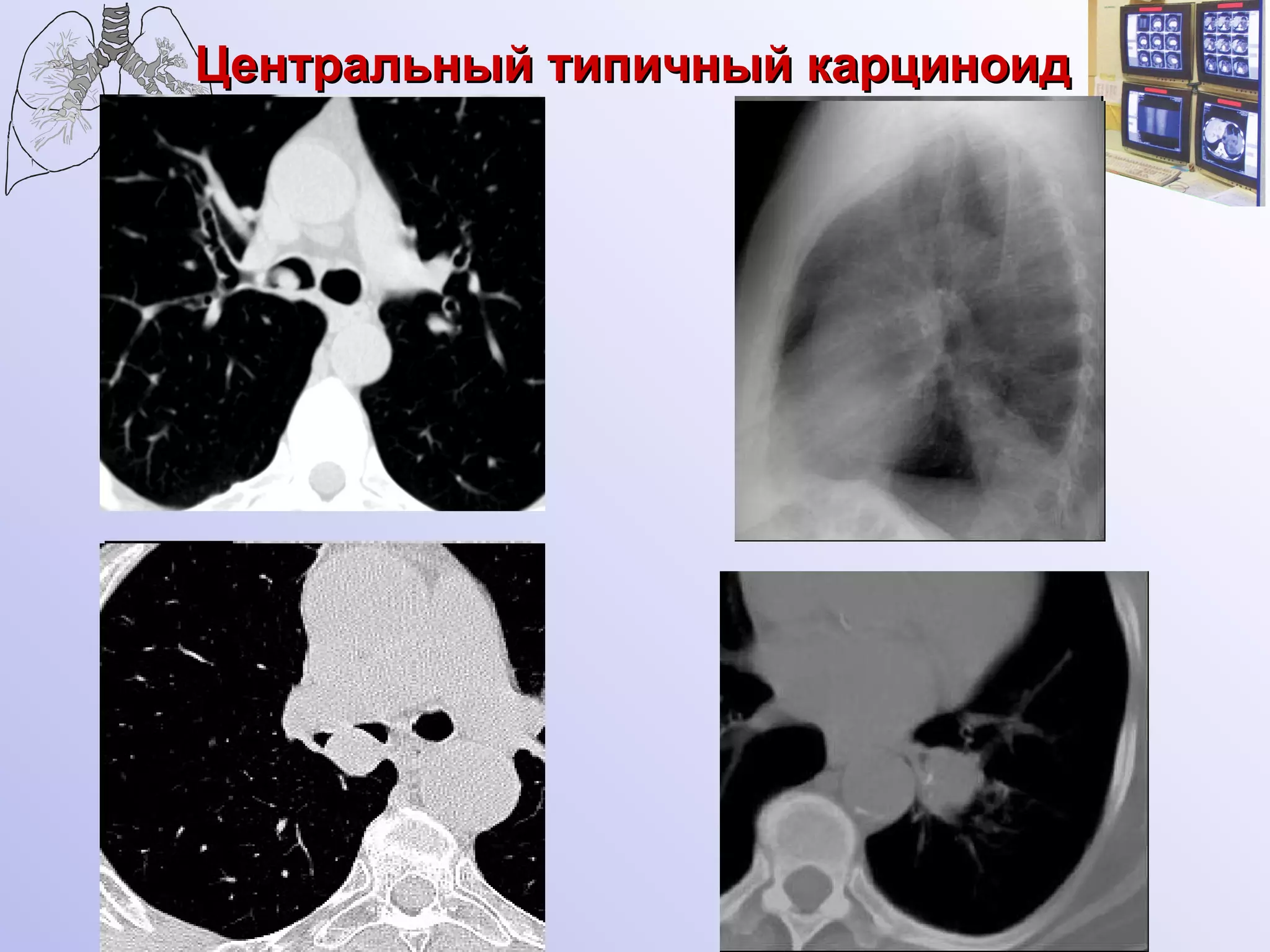 Центральный типичный карциноид 