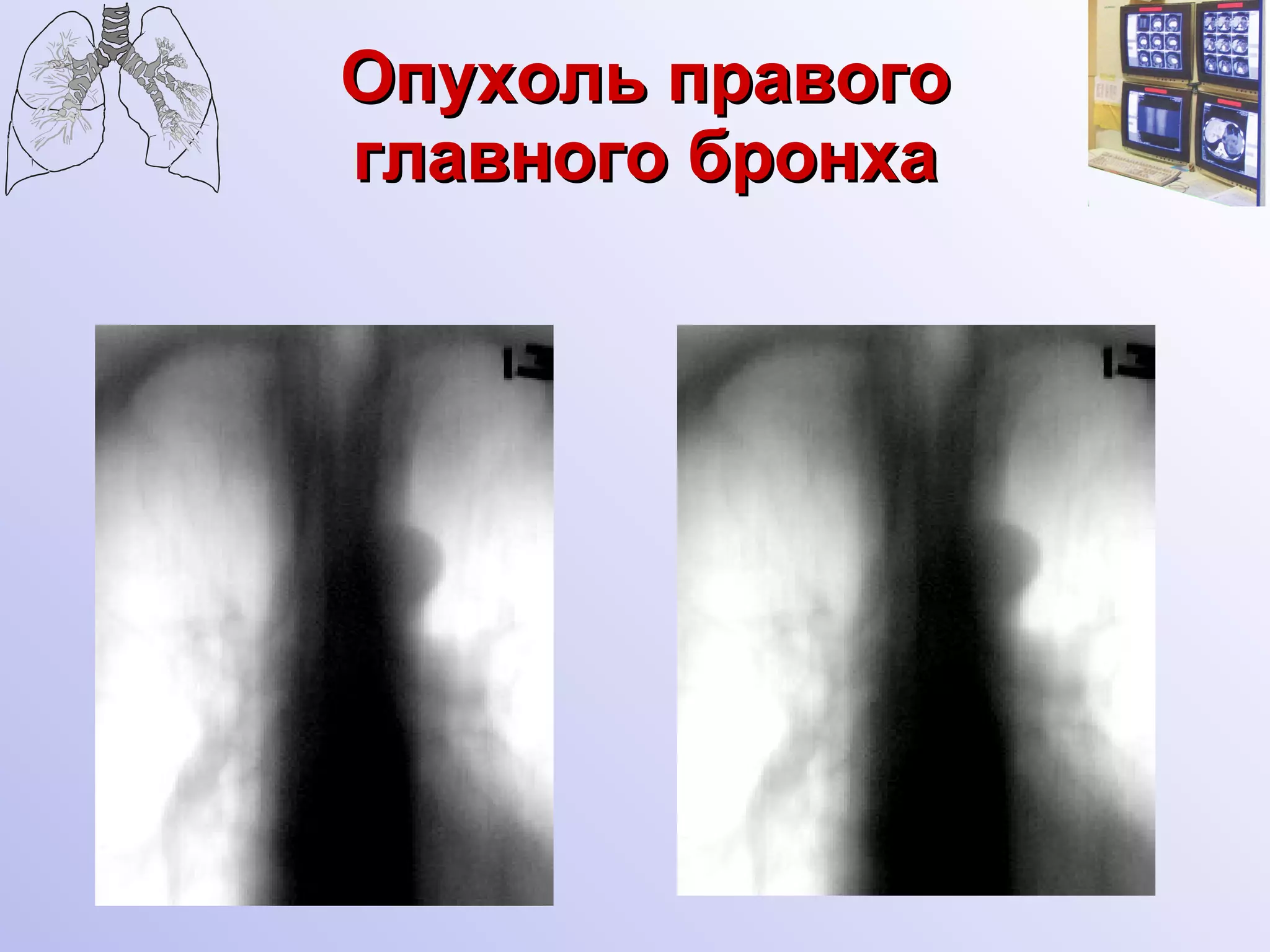 Опухоль правого главного бронха 