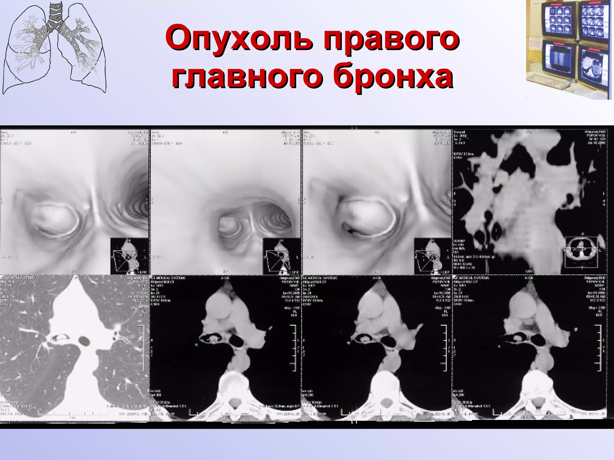 Опухоль правого главного бронха 