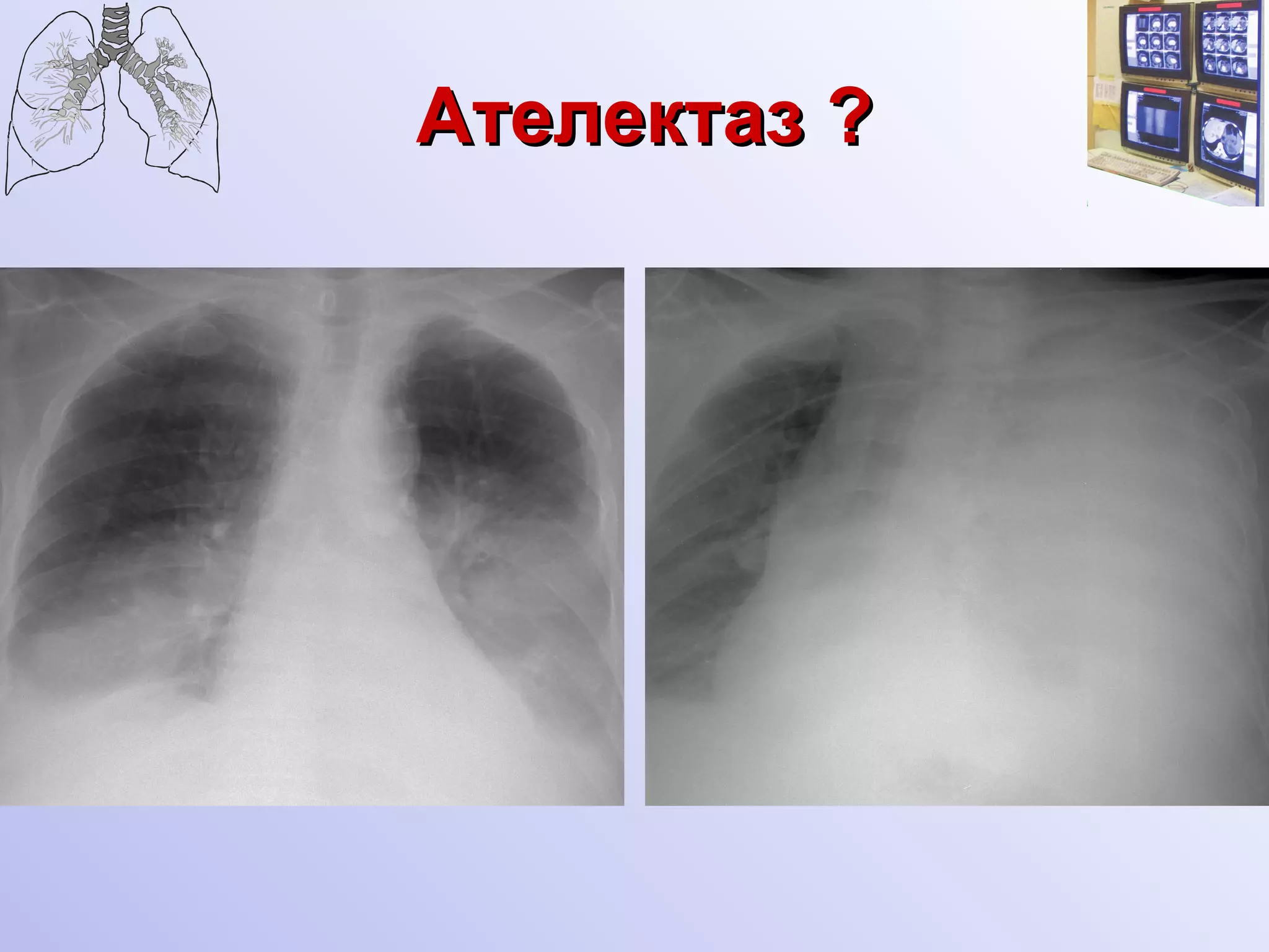 Ателектаз  ? 