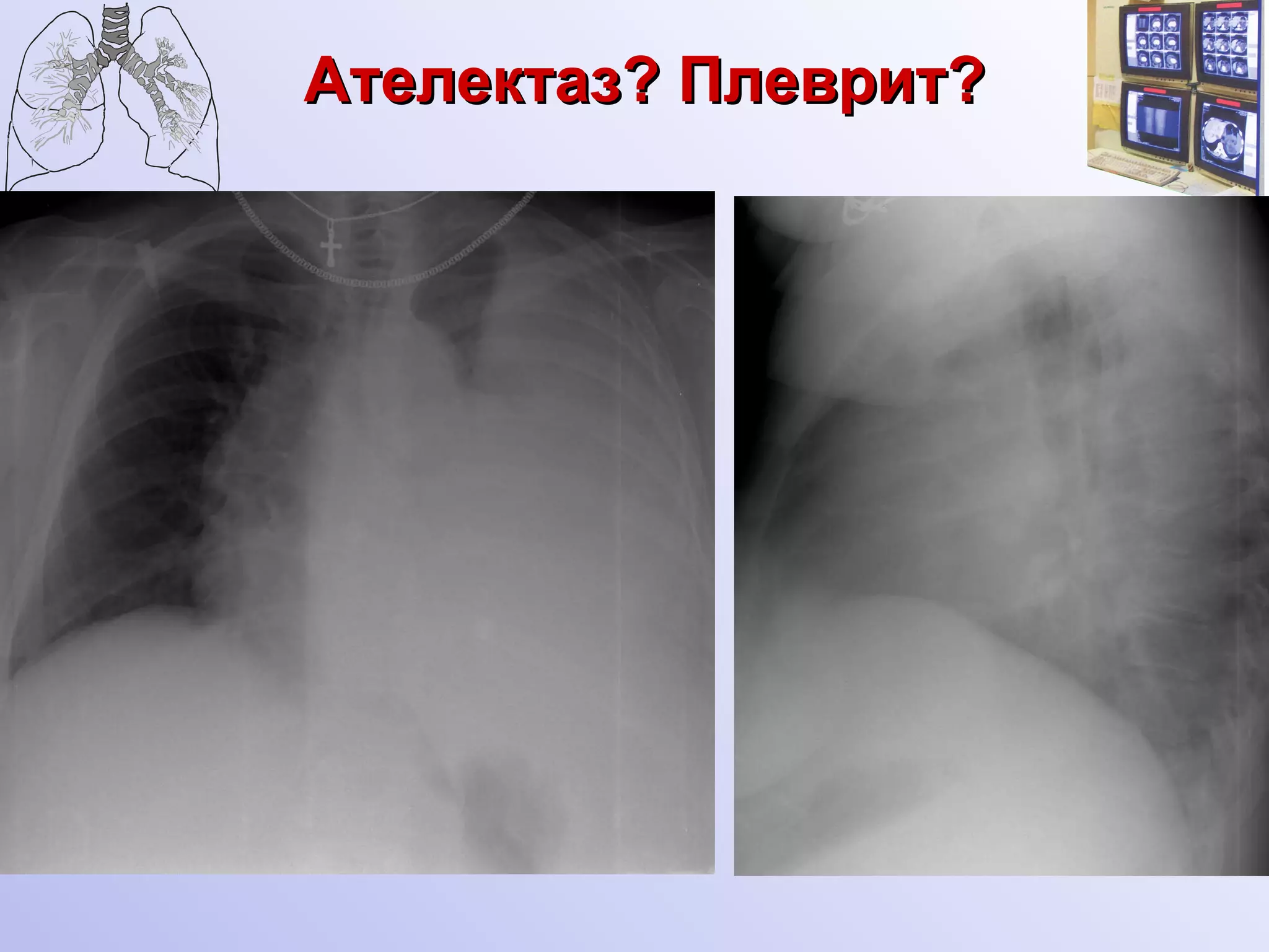 Ателектаз? Плеврит? 