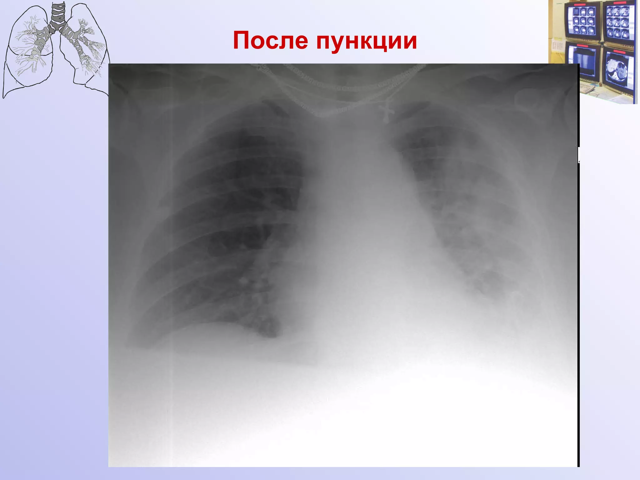 После пункции 