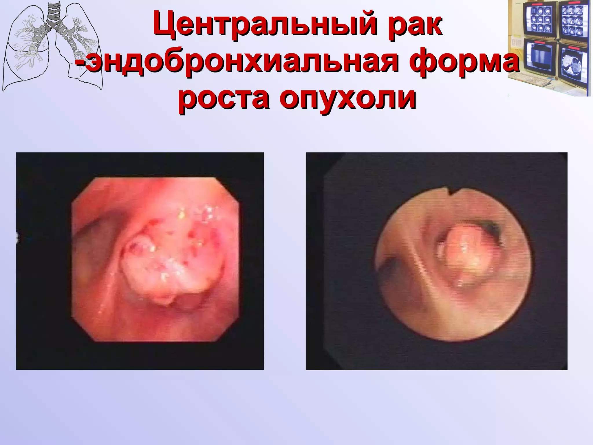 Центральный рак -эндобронхиальная форма роста опухоли 