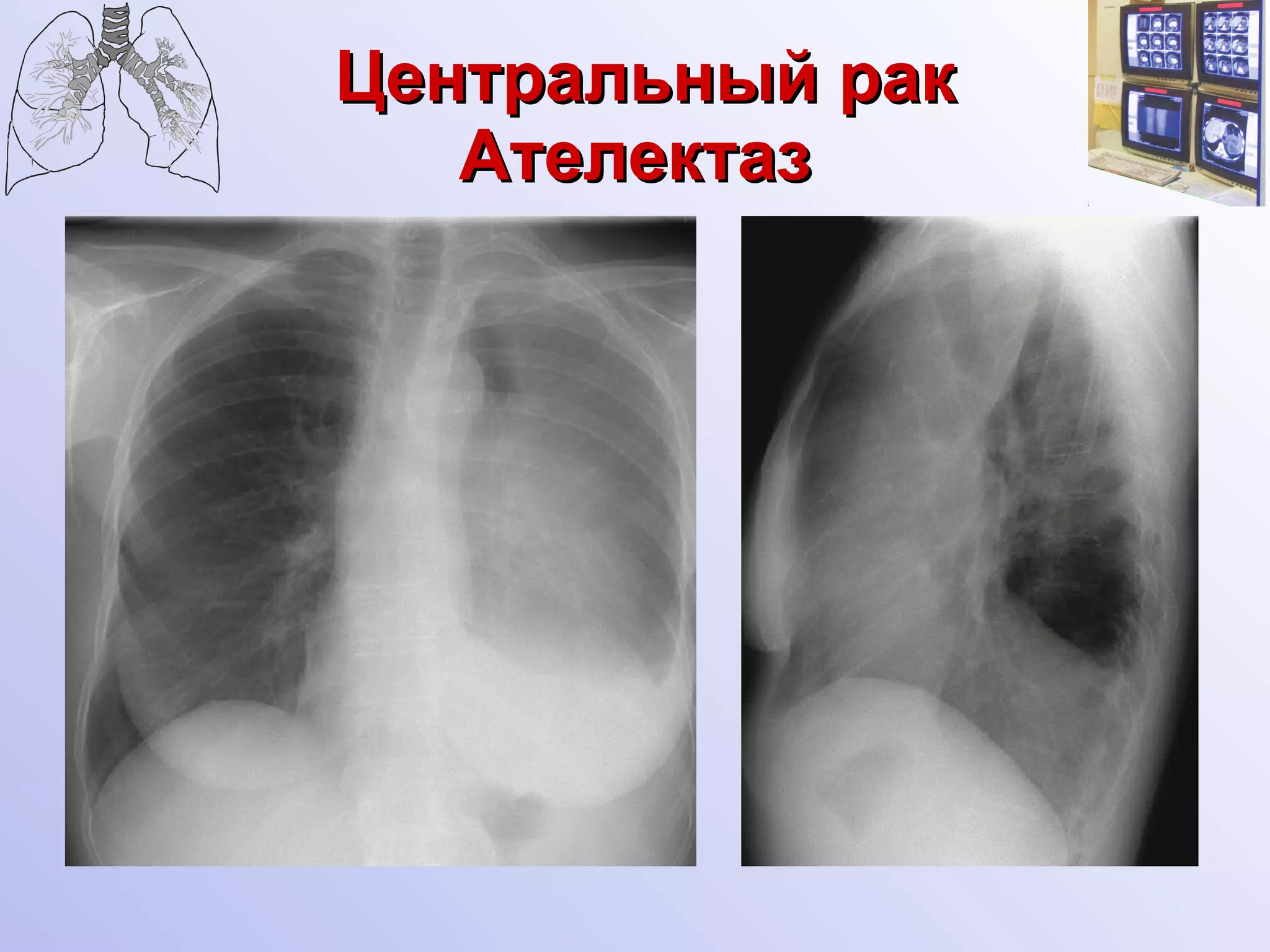 Центральный рак Ателектаз   