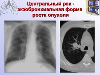 Центральный рак - экзобронхиальная форма  роста опухоли 