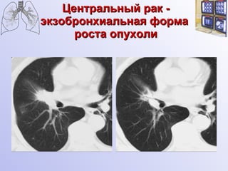 Центральный рак - экзобронхиальная форма  роста опухоли 