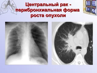 Центральный рак - перибронхиальная форма  роста опухоли 