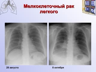 Мелкоклеточный рак легкого 8  октября 28 августа 