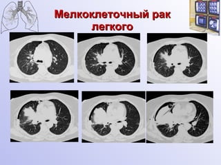 Мелкоклеточный рак легкого 