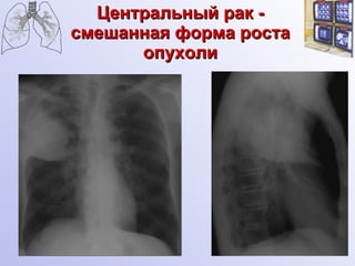 Центральный рак - смешанная форма роста опухоли 