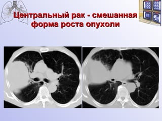Центральный рак - смешанная форма роста опухоли 