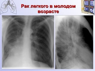 Рак легкого в молодом возрасте 