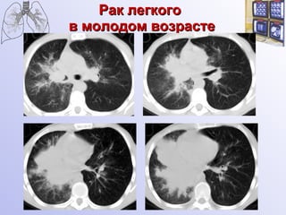 Рак легкого  в молодом возрасте 