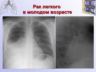 Рак легкого  в молодом возрасте 