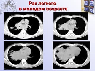 Рак легкого  в молодом возрасте 