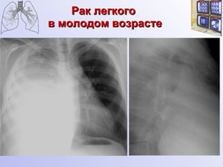 Рак легкого  в молодом возрасте 