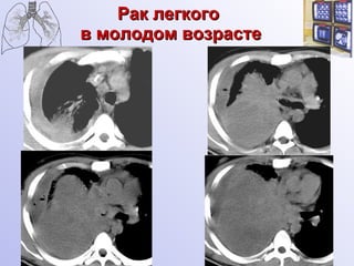 Рак легкого  в молодом возрасте 