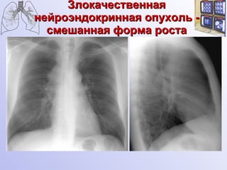 Злокачественная нейроэндокринная опухоль - смешанная форма роста 