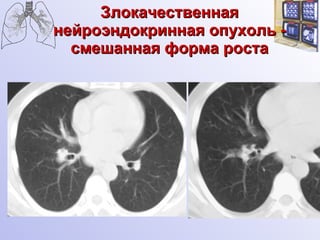 Злокачественная нейроэндокринная опухоль - смешанная форма роста 