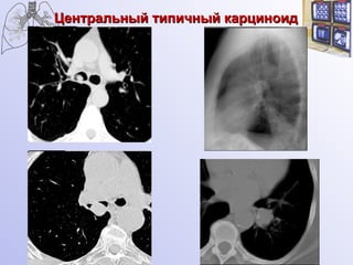 Центральный типичный карциноид 