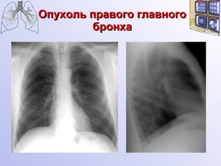 Опухоль правого главного бронха 
