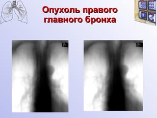Опухоль правого главного бронха 