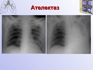 Ателектаз   