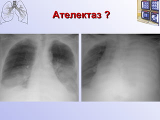 Ателектаз  ? 
