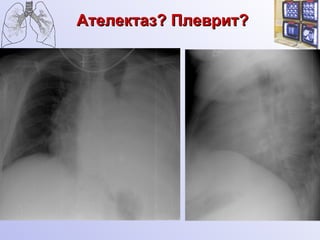 Ателектаз? Плеврит? 